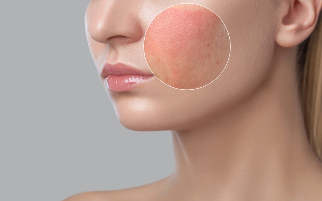 redness minimizer treatments and products in winnipeg