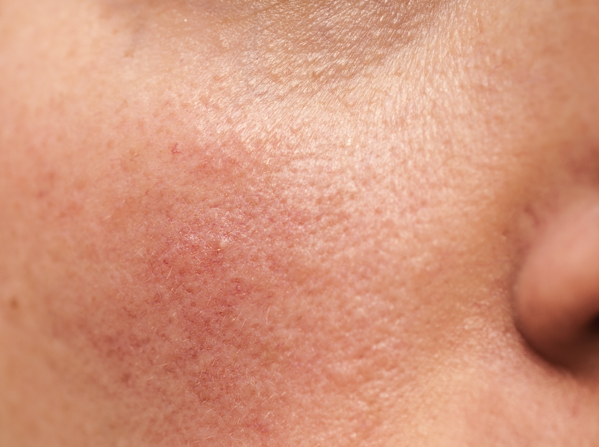 redness rosacea solutions