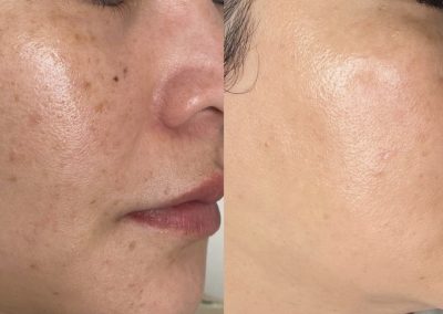 acne scar treatment winnipeg pigmentation laser