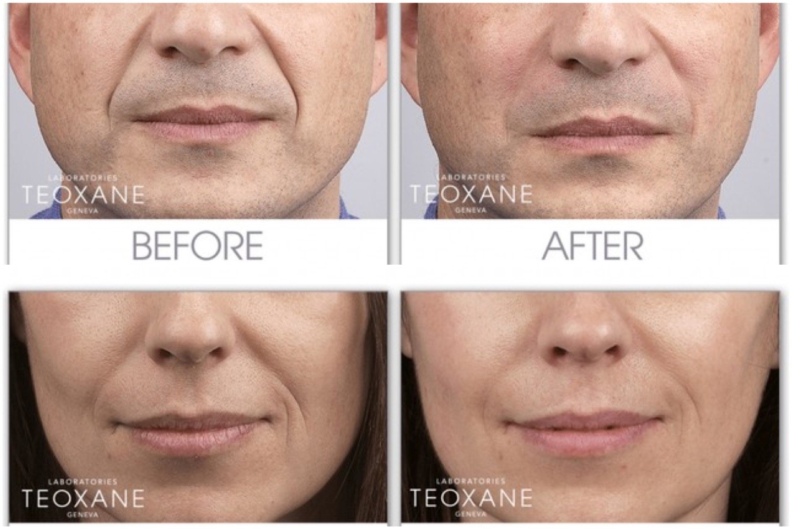 beauty booster treatment before and after