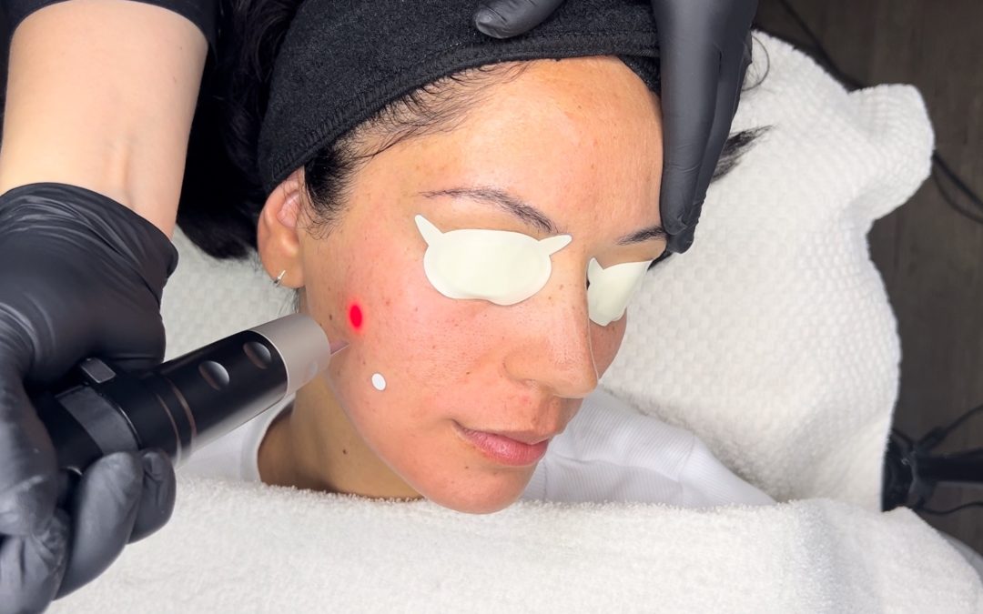 My Experience Getting a Skin Resurfacing Laser Treatment