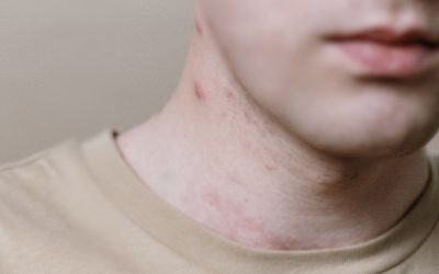 3 Ways to Treat & Prevent Neck Acne