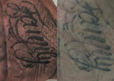 Before and after one tattoo removal treatment. Courtesy of Shauna M at Total Wrapture.