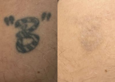 Before and after three tattoo removal treatments. Courtesy of Shauna M at Total Wrapture.