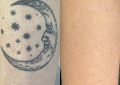 Before and after five tattoo removal treatments. Courtesy of Shauna M at Total Wrapture.