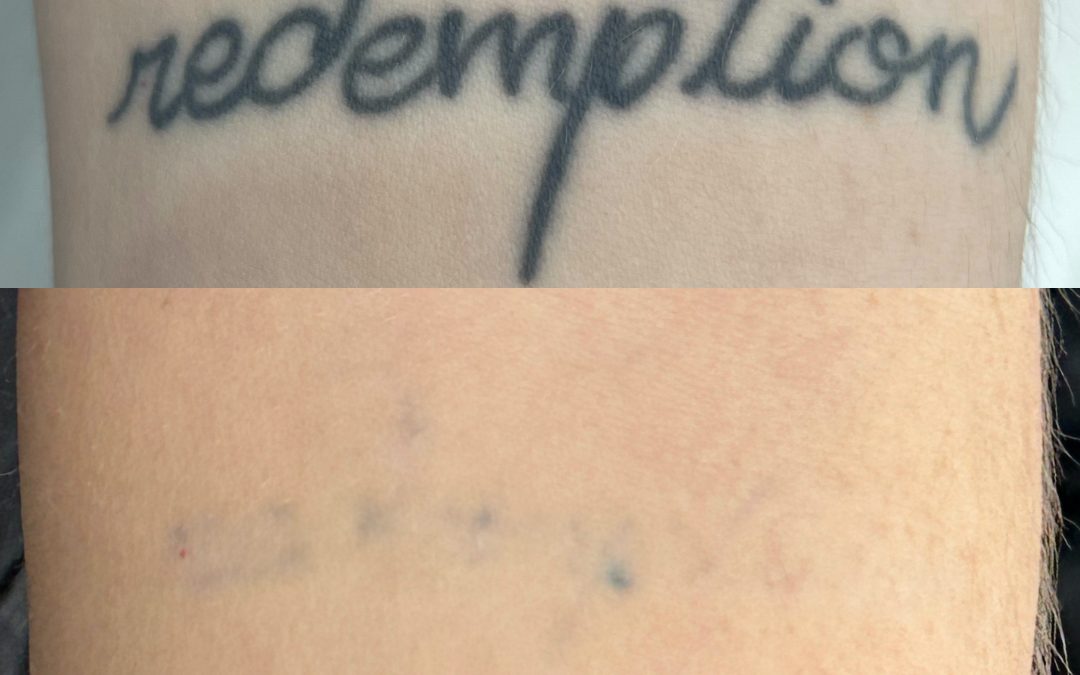 Before and after five tattoo removal treatments. Courtesy of Shauna M at Total Wrapture.
