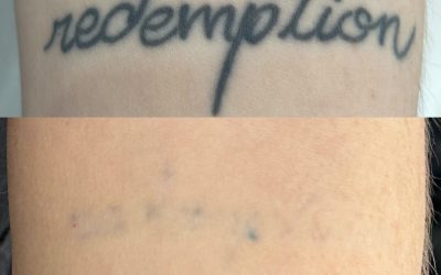Tattoo Removal in Winnipeg: What to Expect