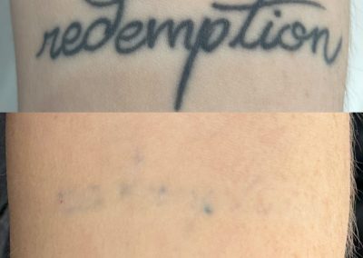 Before and after five tattoo removal treatments. Courtesy of Shauna M at Total Wrapture.
