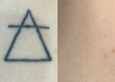 Before and after five tattoo removal treatments. Courtesy of Shauna M. at Total Wrapture.