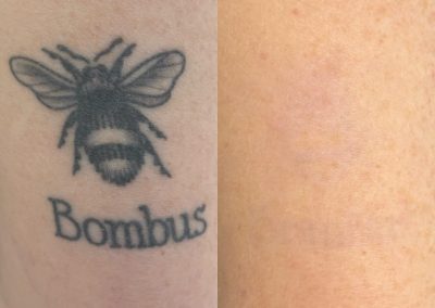 Before and after five tattoo removal treatments. Courtesy of Shauna M at Total Wrapture.
