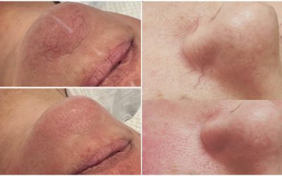 Little Facial Veins: What Causes Broken Capillaries?