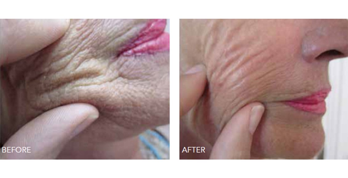 Difference before and after a beauty booster treatment. Skin appears less wrinkled.