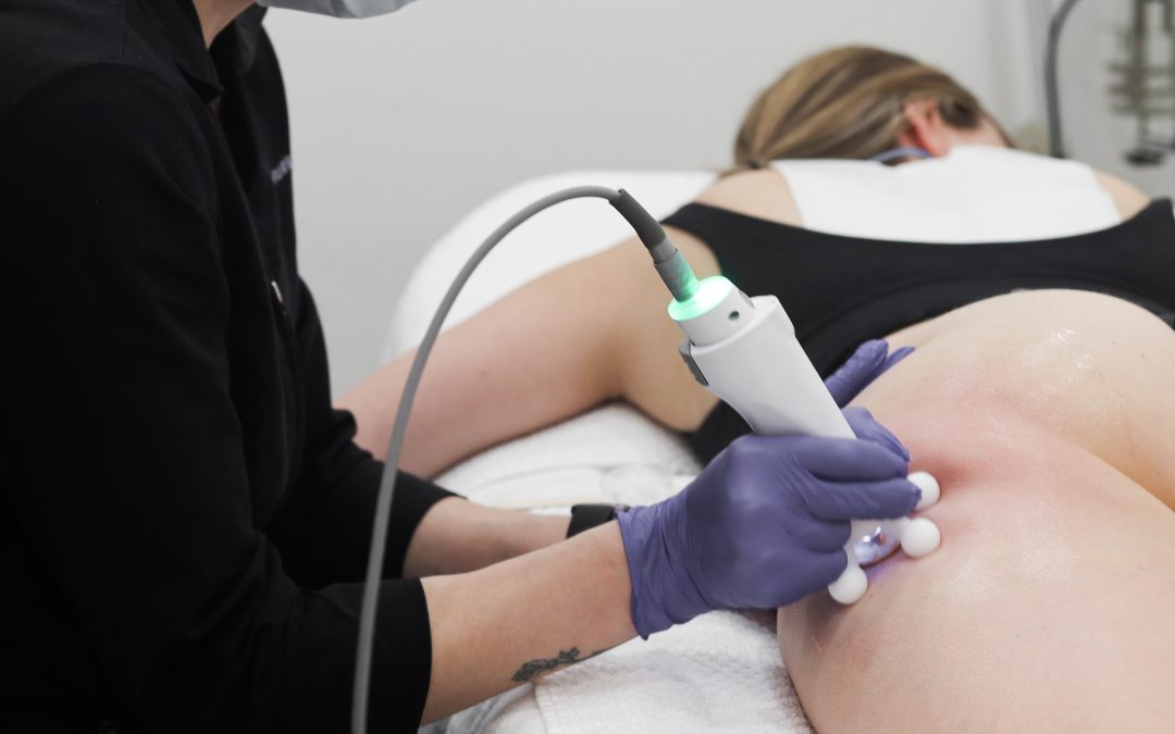 Treating Cellulite in Winnipeg: 6 Reasons Why RF Should Be on Your Radar