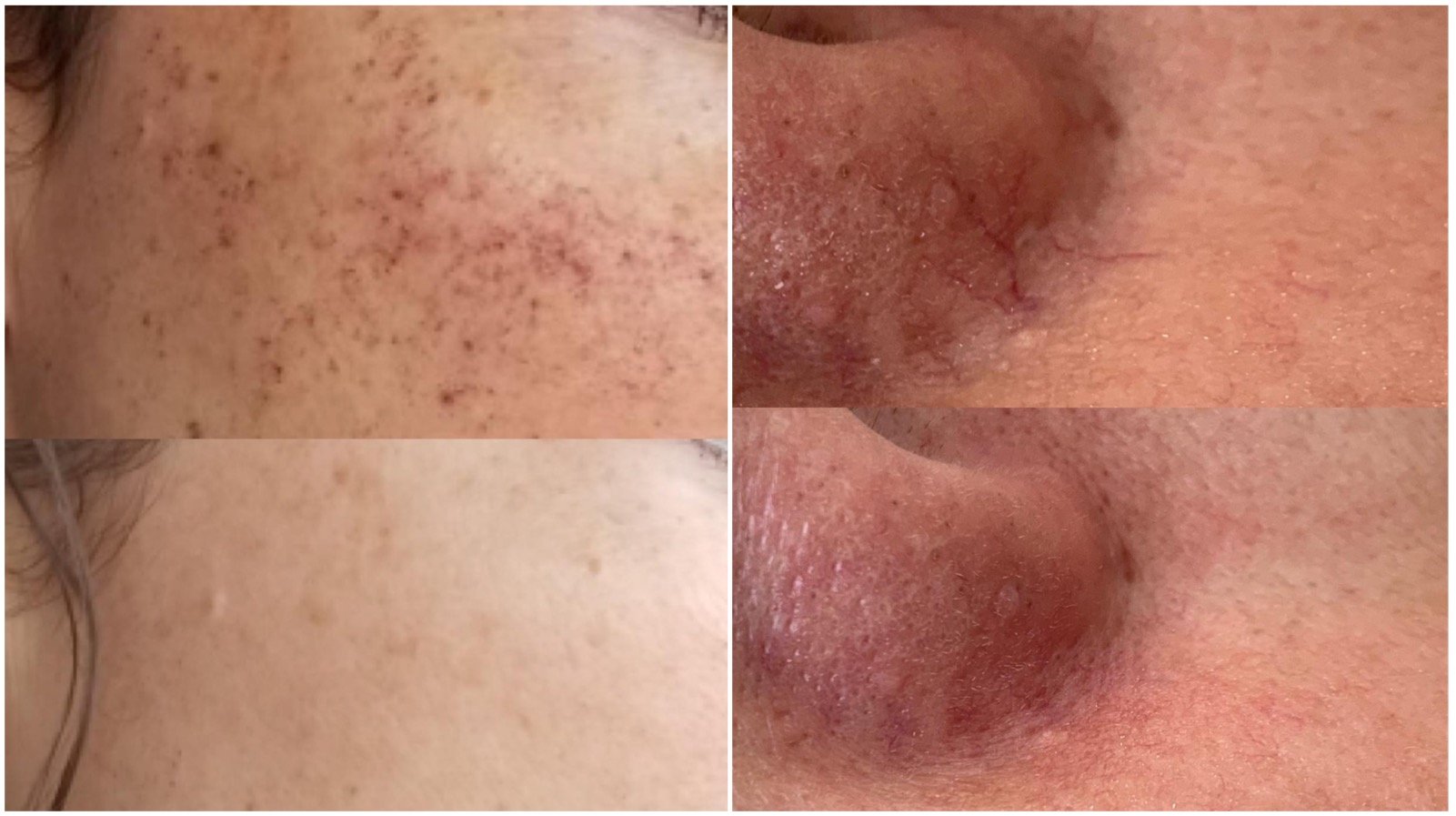 "Comparison of skin with broken facial vessels before and after a photofacial procedure."