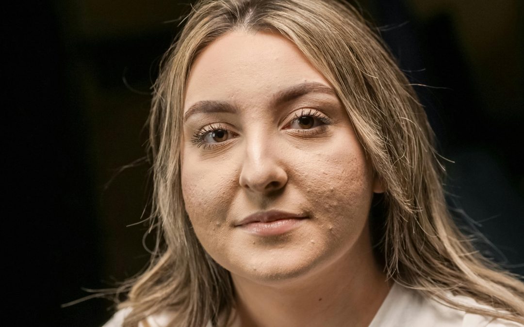 Woman with blonde hair and acne