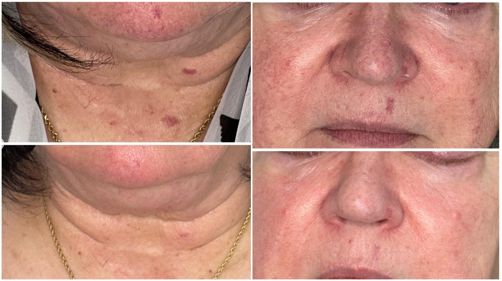 "Skin showing broken facial vessels before and after a photofacial."