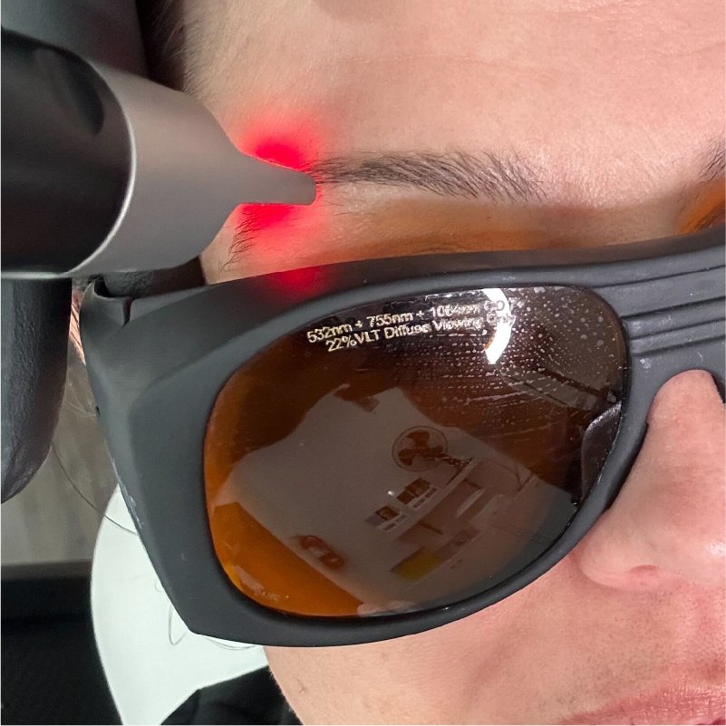 Laser microblading removal at Total Wrapture Medi Spa