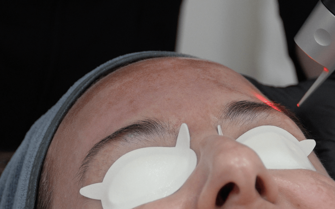 "person getting brow laser with picosure"