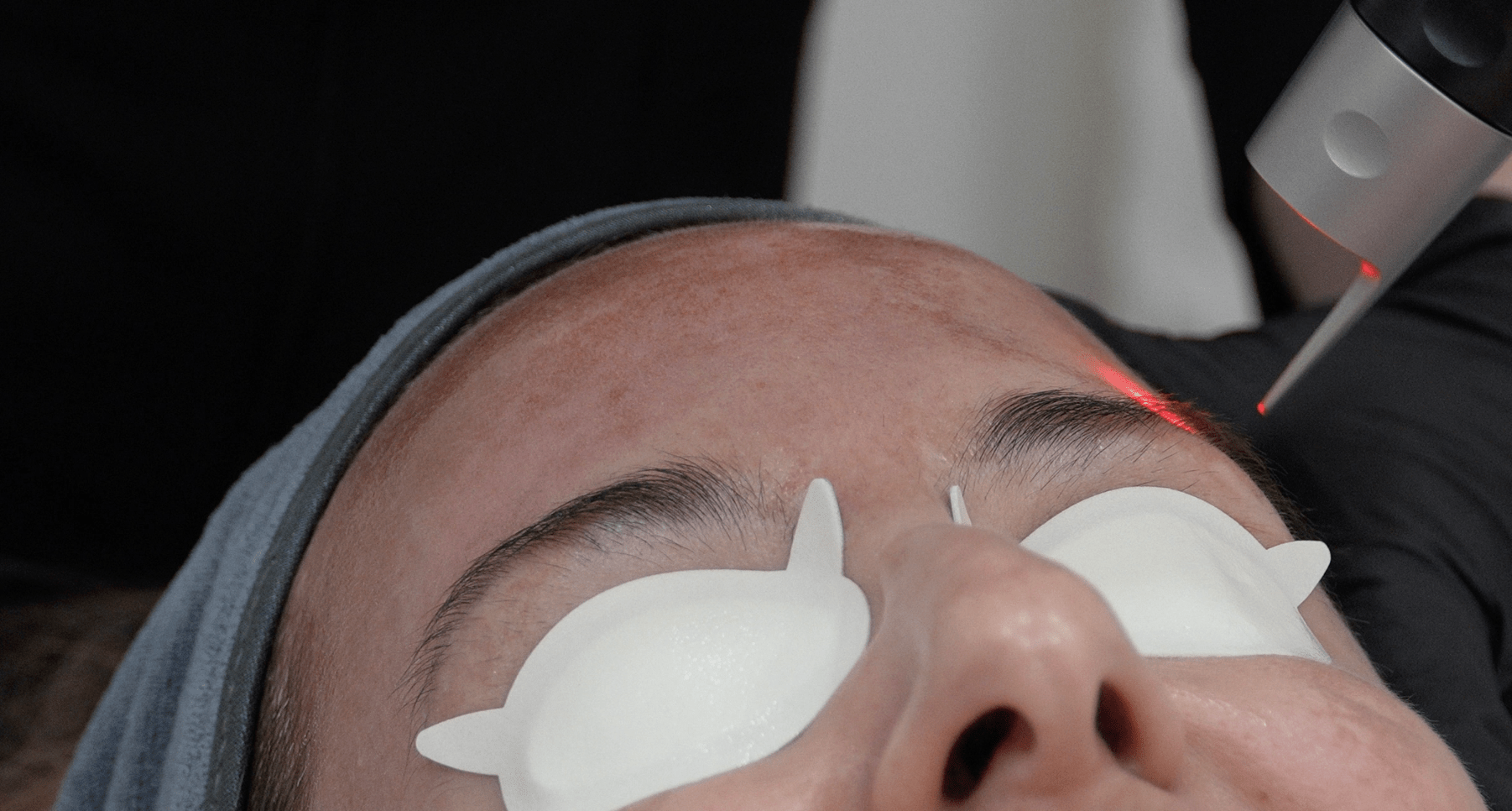 "person getting brow laser with picosure"