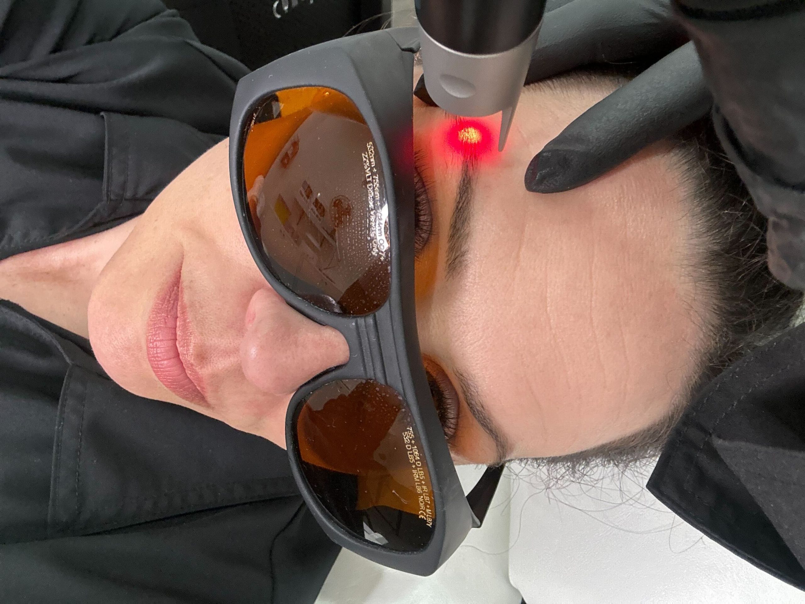 "microblading removal with a laser"