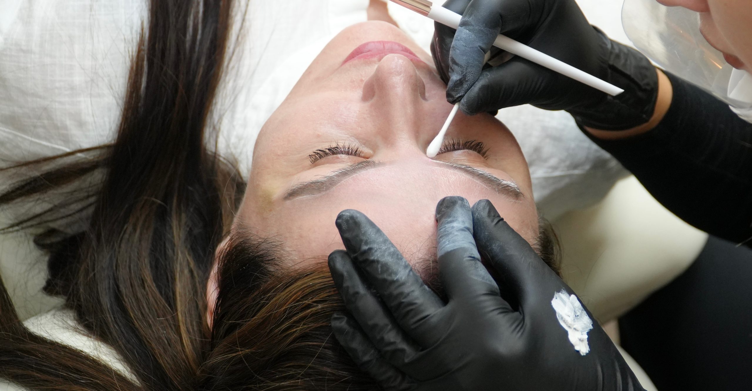 "laser technician removing brow pigmentation with a laser"