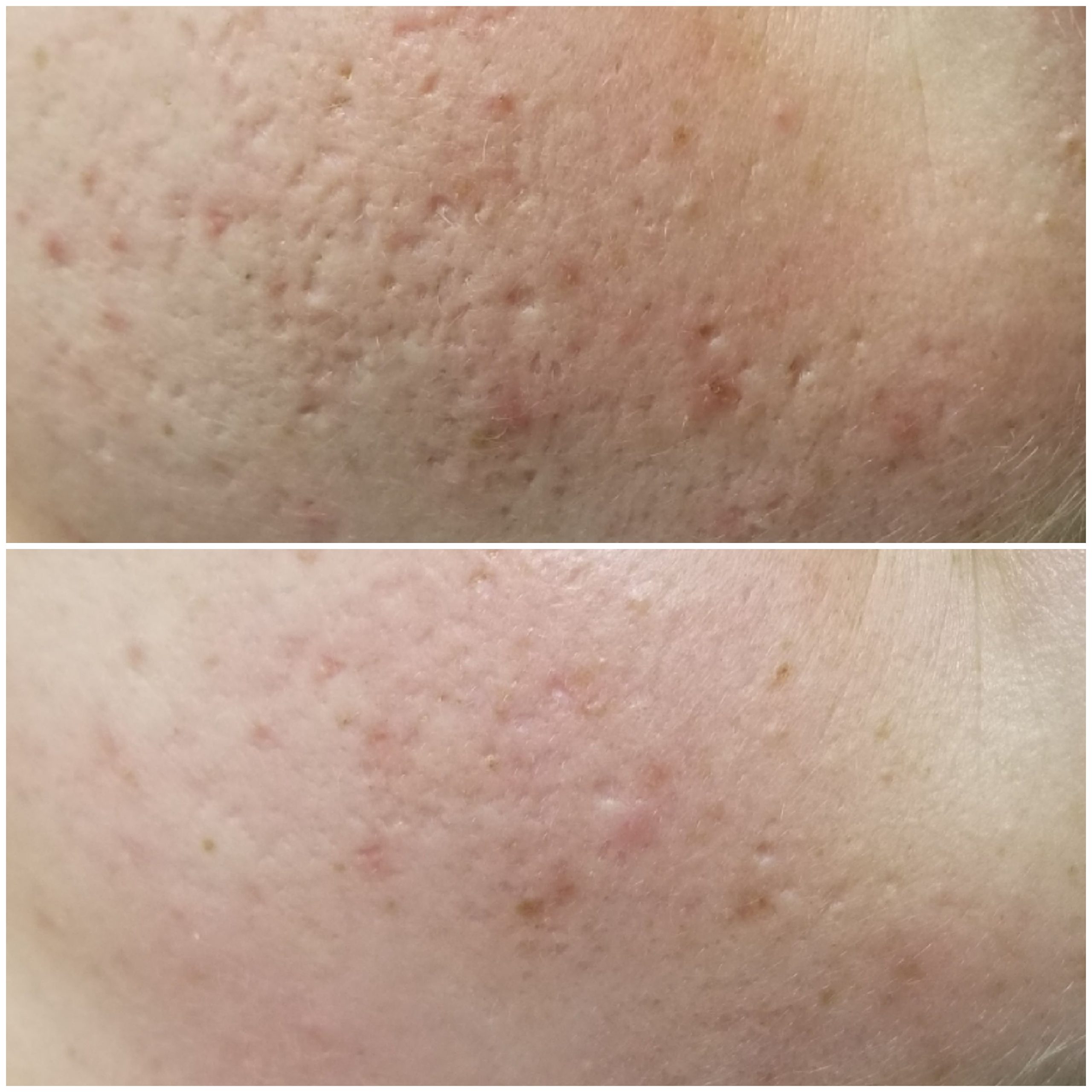 results of a microneedling treatment showing smoother skin and reduced scars