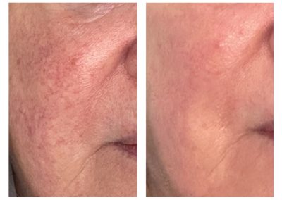 treatment results showing redness and blotchy complexion cleared up