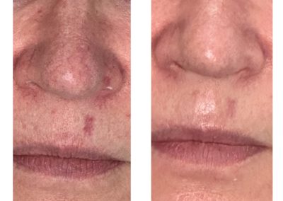 treatment results showing broken capillaries and blotchy complexion cleared up