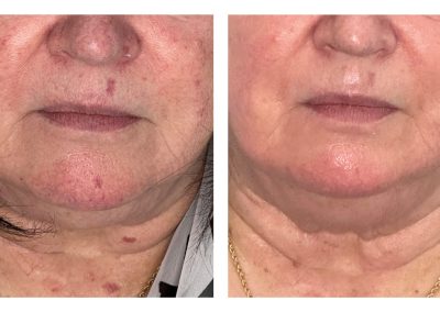 treatment results showing broken capillaries, scars, and blotchy complexion cleared up