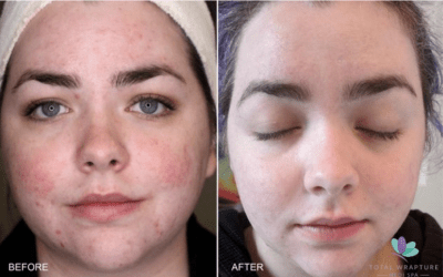 Microneedling in Winnipeg: Is This Treatment Really Worth It?