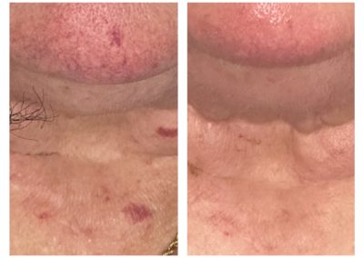 treatment results showing age spots, pigmented scars, and redness cleared up