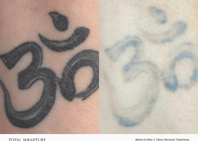 Result of tattoo removal. PicoSure tattoo removal before and after two treatments.
