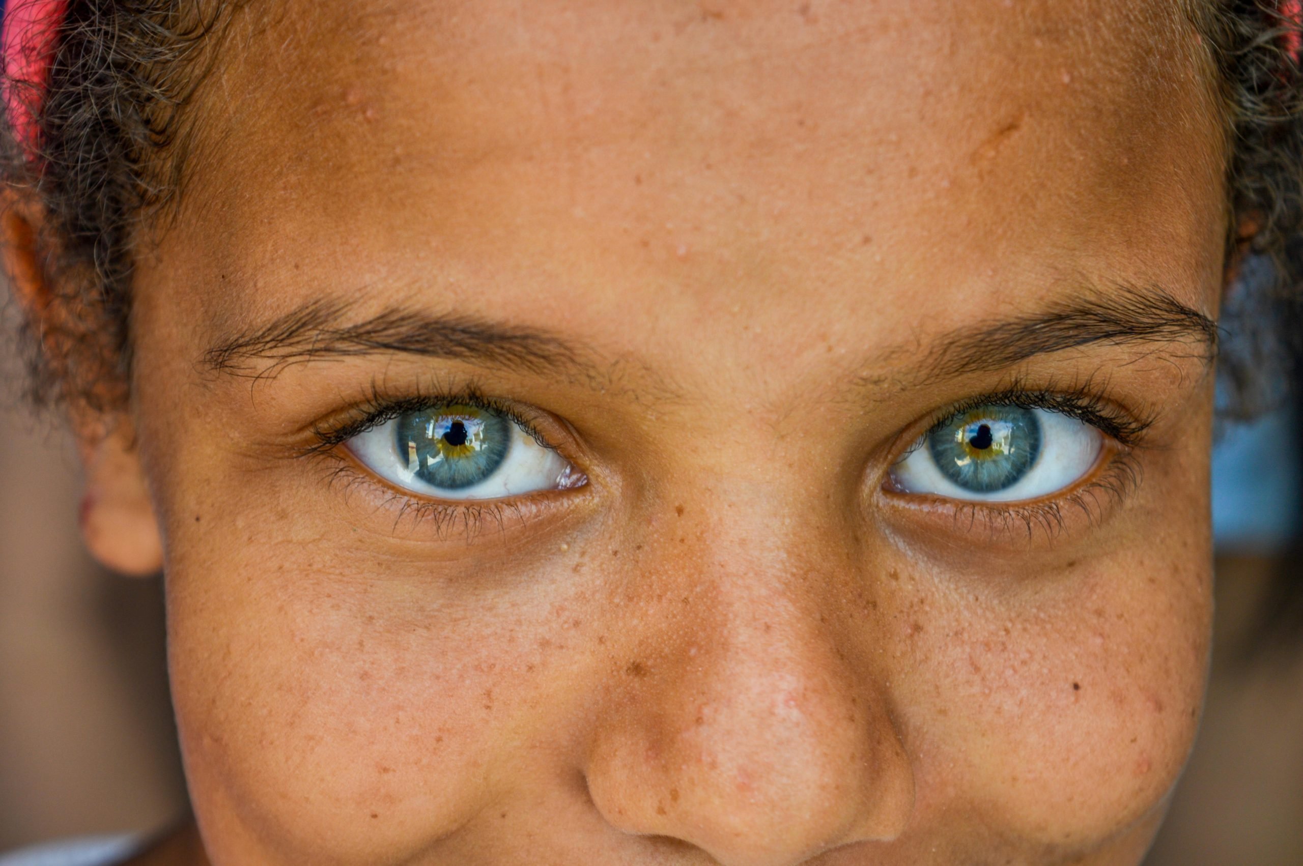 person with green eyes and freckles who knos how to prevent hyperpigmentatiion