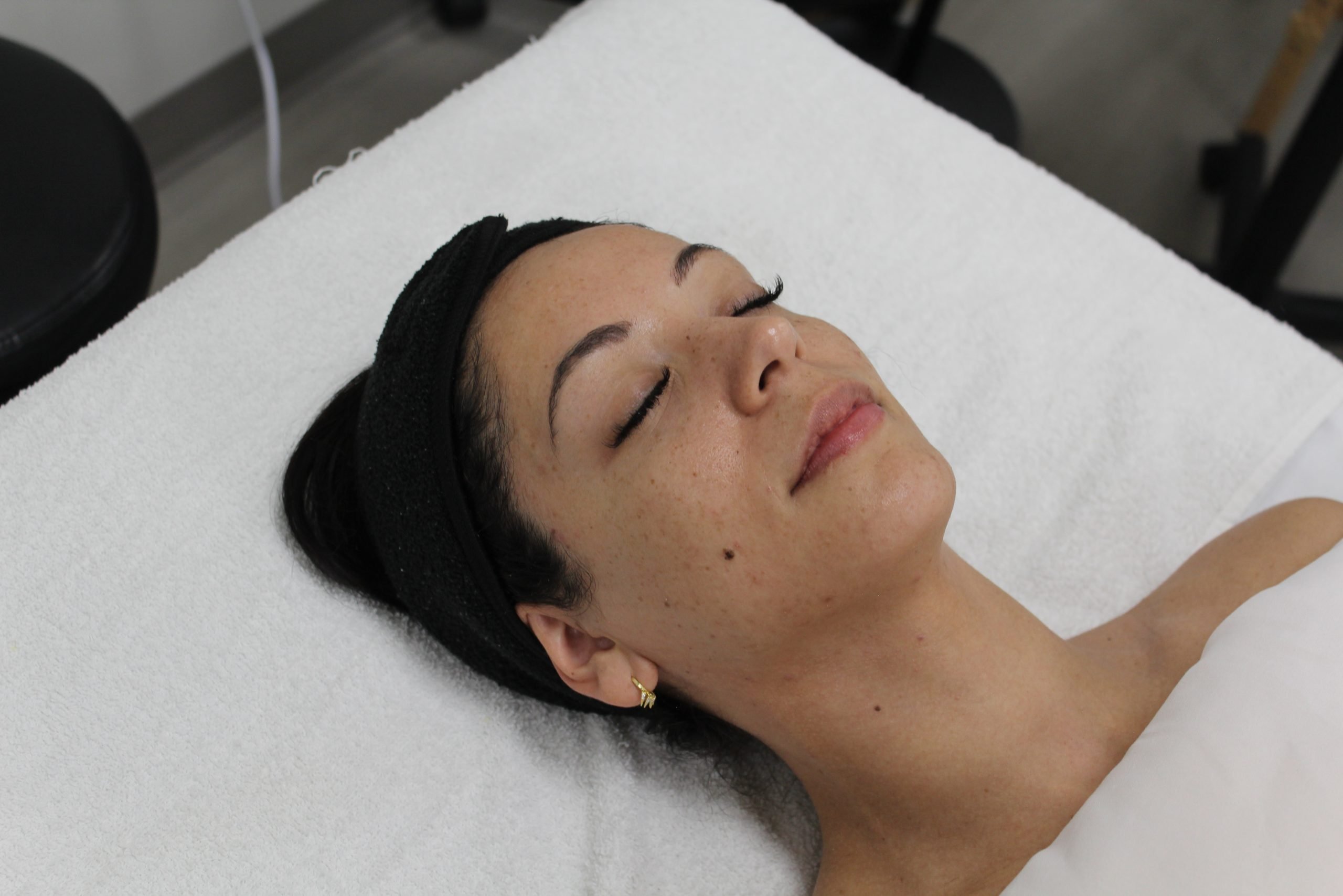 Person lying on a facial bed with skin prone to hyperpigmentation