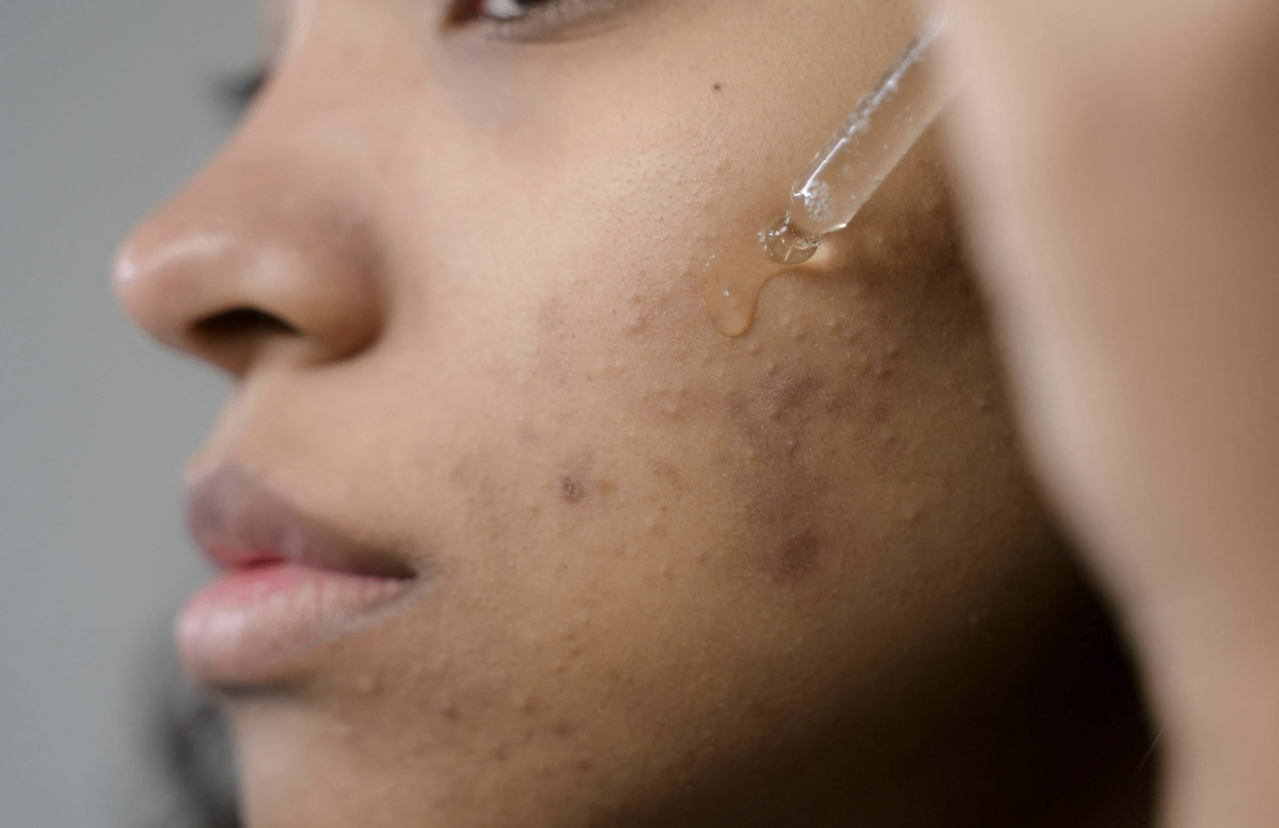 A person with pigmented acne scars