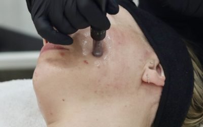 Which Treatment is Best for Acne?