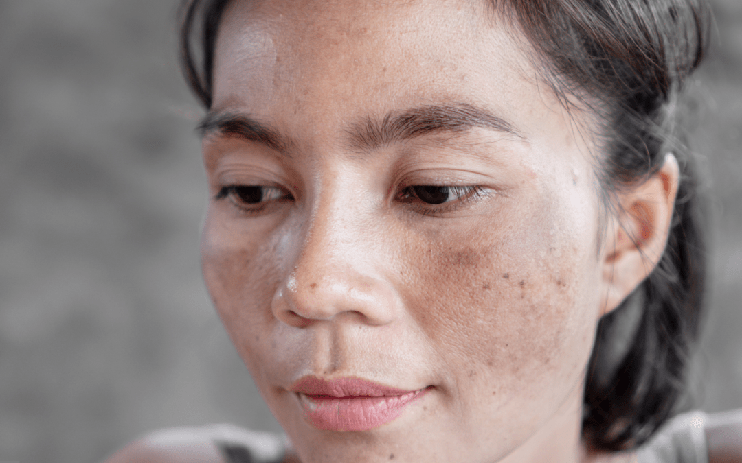 A person with hyperpigmentation on their cheek and chin