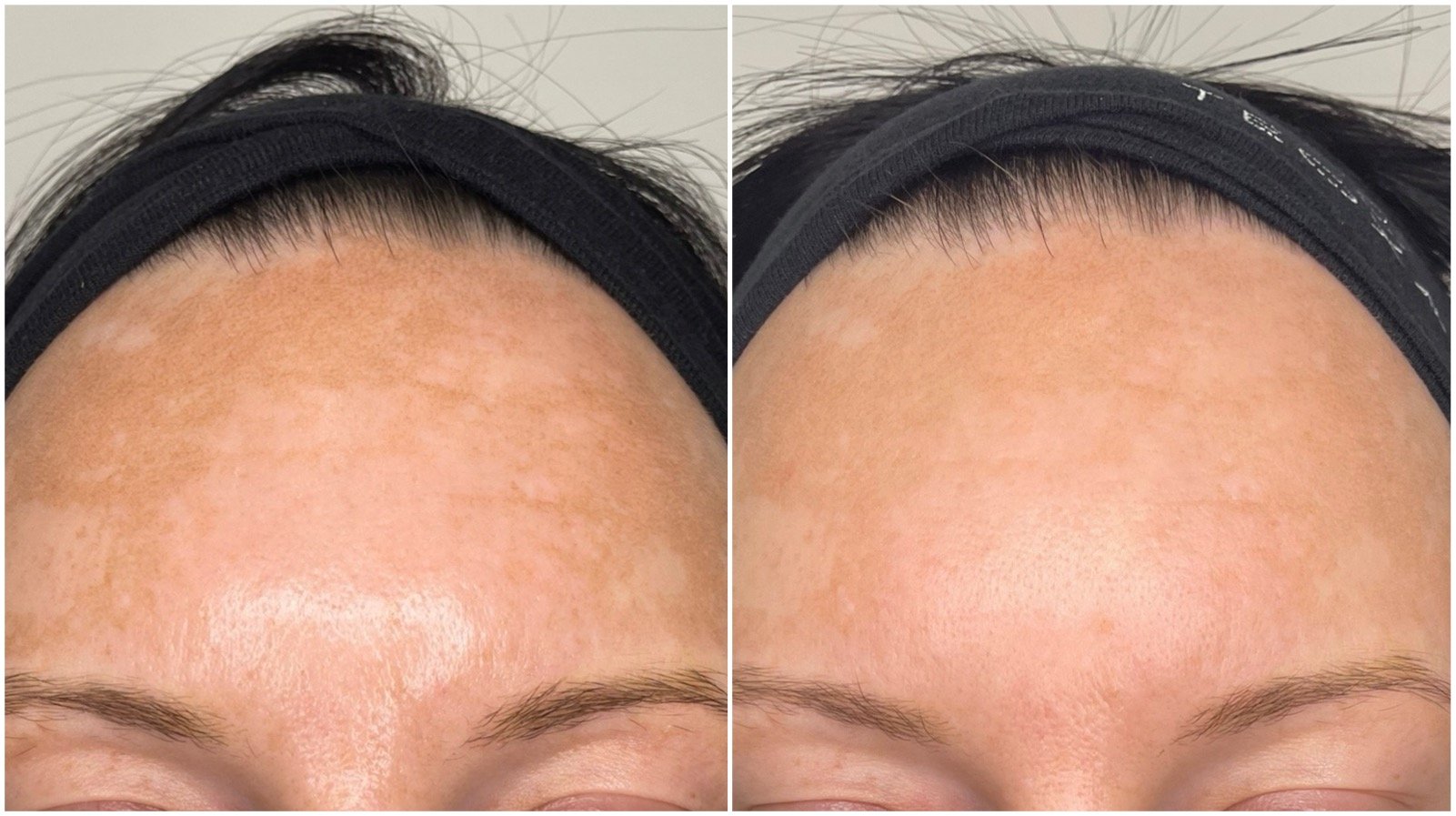 Before and after photos of hyperpigmentation treated with one PicoSure laser session by laser technician Amy, complemented by Vivier Hydroquinone products. Noticeable lightening of melasma and pigmented patches.
